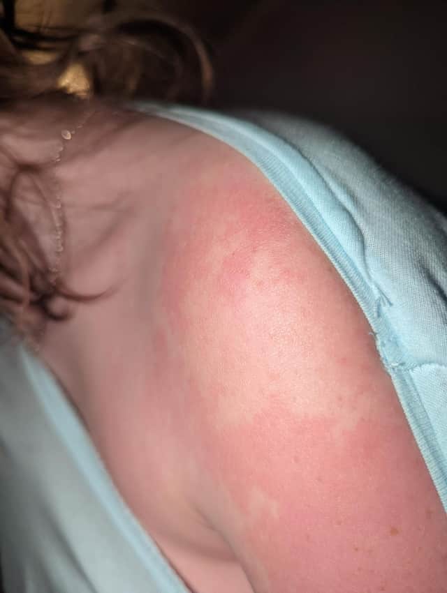 Rash is a symptom of scarlet fever.