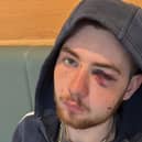 Connor Muirhead (21) sustained injuries to his face after he was assaulted.