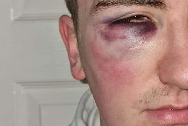 A photograph of a black eye and bruising suffered by Aodhán Roberts at the weekend.