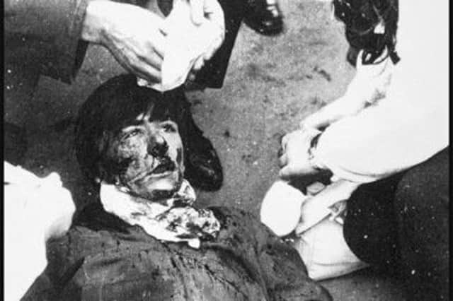 1972... Michael Quinn after he was shot in the face on Bloody Sunday.
