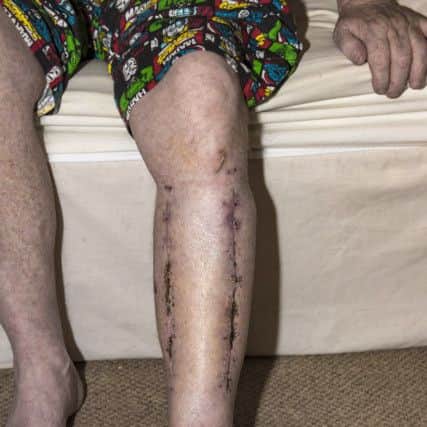 Gerry Heaney shows the scares on his leg, the result of a paramilitary style gun attack, carried out by masked men, on October 5th last. DER4518GS003