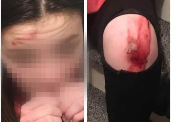 The 12 year-old girl sustained cuts to her forehead and legs when she was struck by a car that failed to stop.